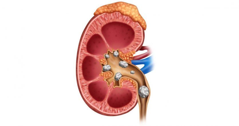 does calcium cause renal stones