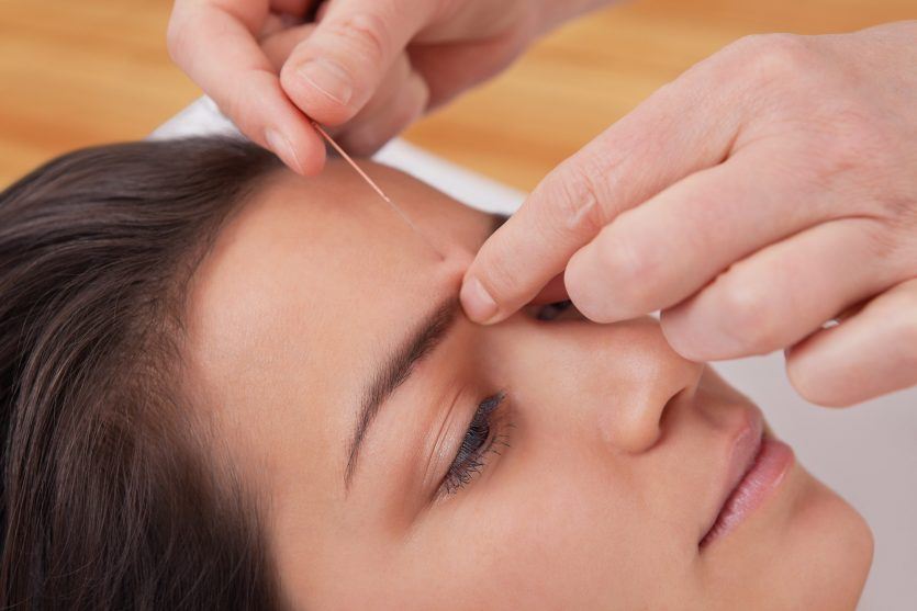 Acupuncture needles on head of a young woman at the spa tcm