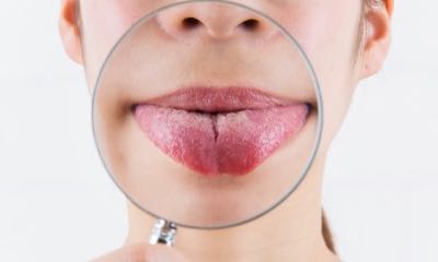 dehydration symptoms tongue